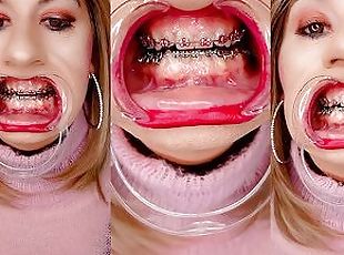 Braces fetish! See Alexandra Braces with an open mouth expander